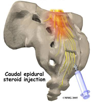Caudal epidural steroid injection complications
