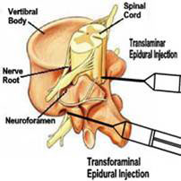 Epidural steroid injection for spinal stenosis