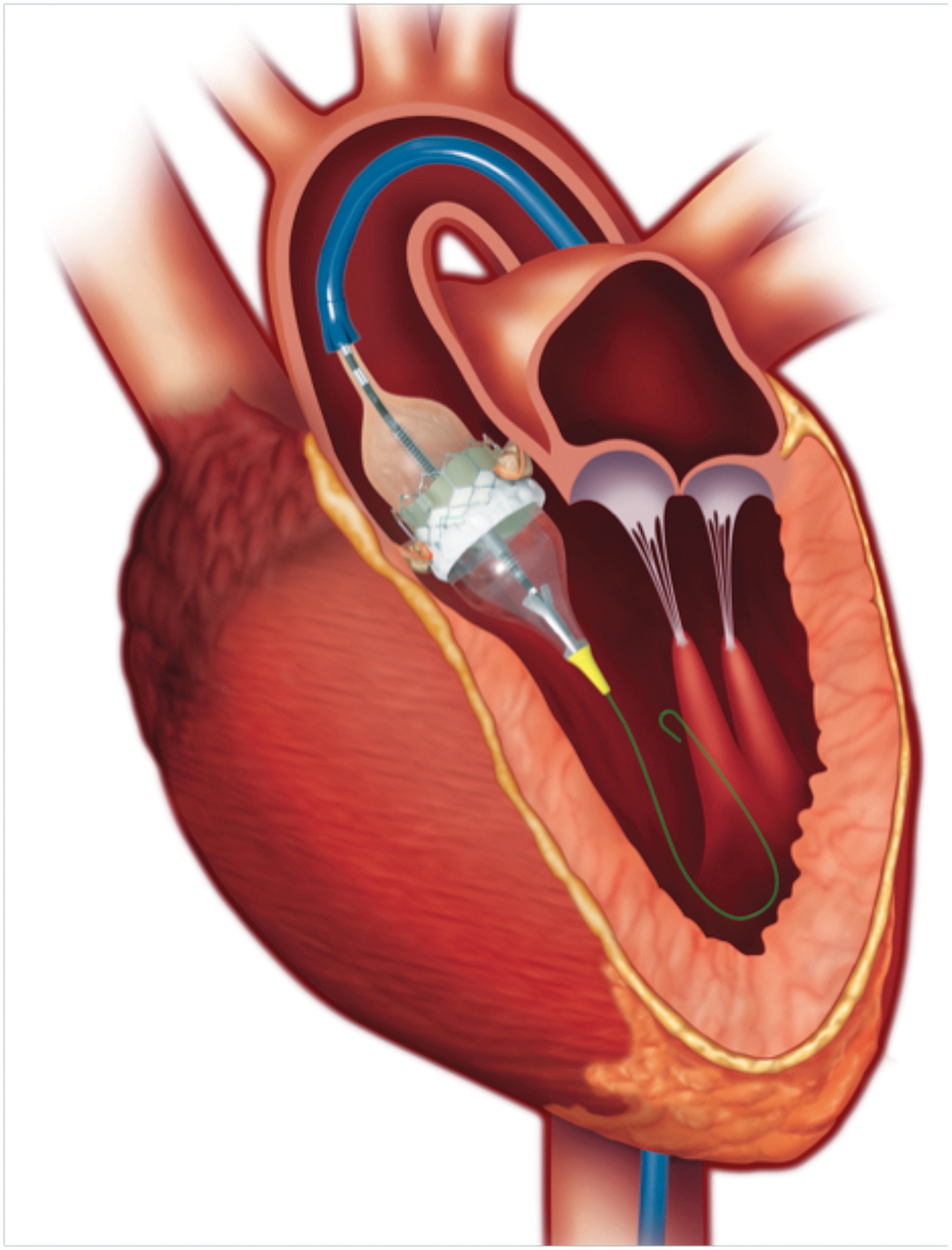 Houston Methodist The Woodlands now offers two Transcatheter Aortic Valve  Replacement Options - Hello Woodlands