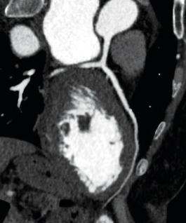 ventricular tachycardia