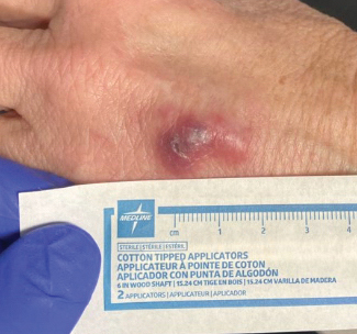 herpes simplex