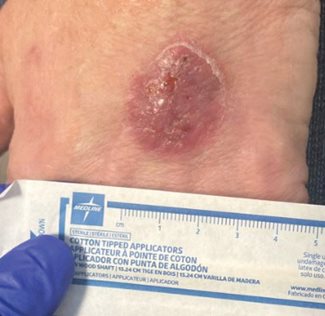 herpes simplex