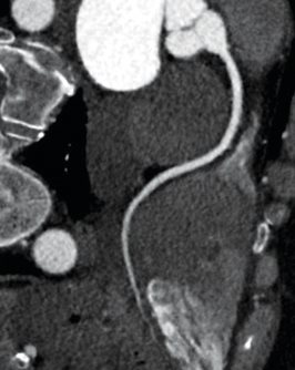 ventricular tachycardia