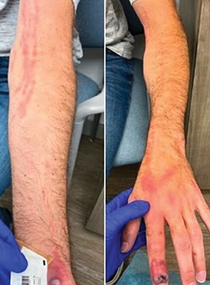 Mpox cellulitis