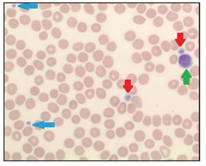 thrombocytopenia