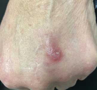herpes simplex
