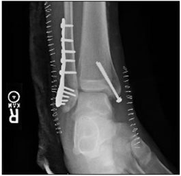 fracture, ankle