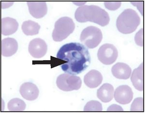 thrombocytopenia