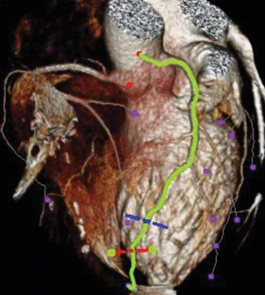 ventricular tachycardia