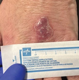 herpes simplex