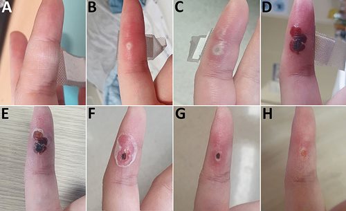 Mpox lesion progression