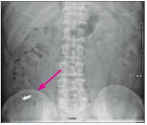 dental implant ingestion